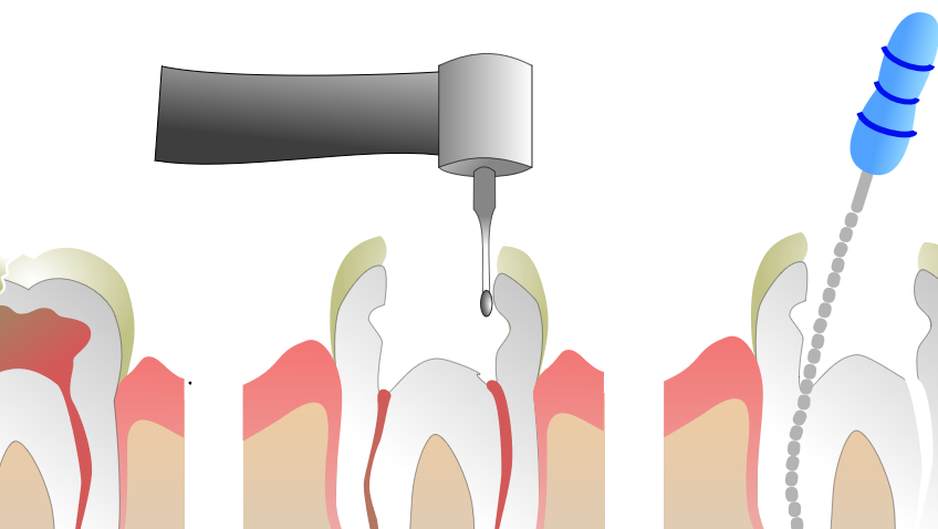 root canal therapy